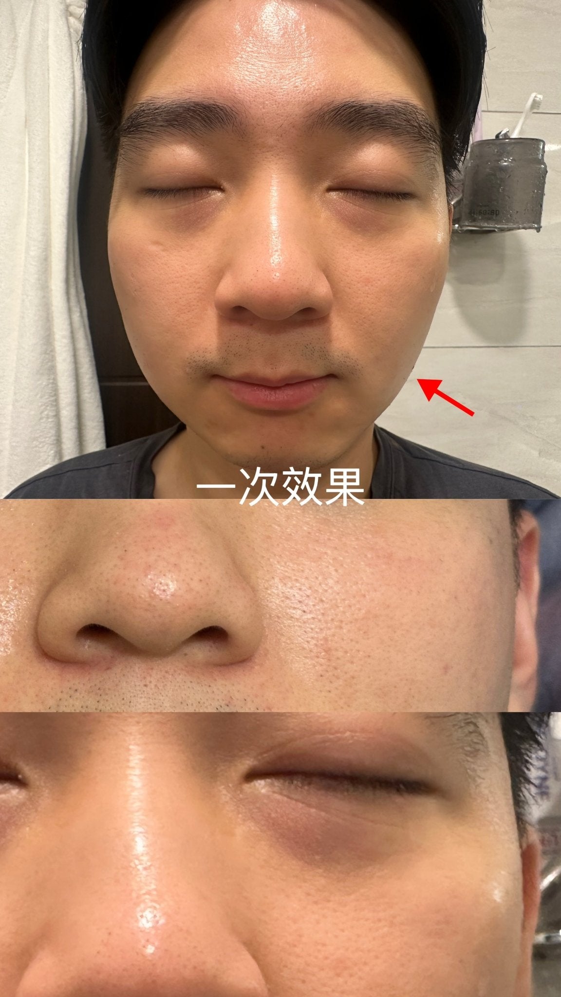 0.2 mm 可溶透明質酸微針滾輪 - LEMOI - PEAU