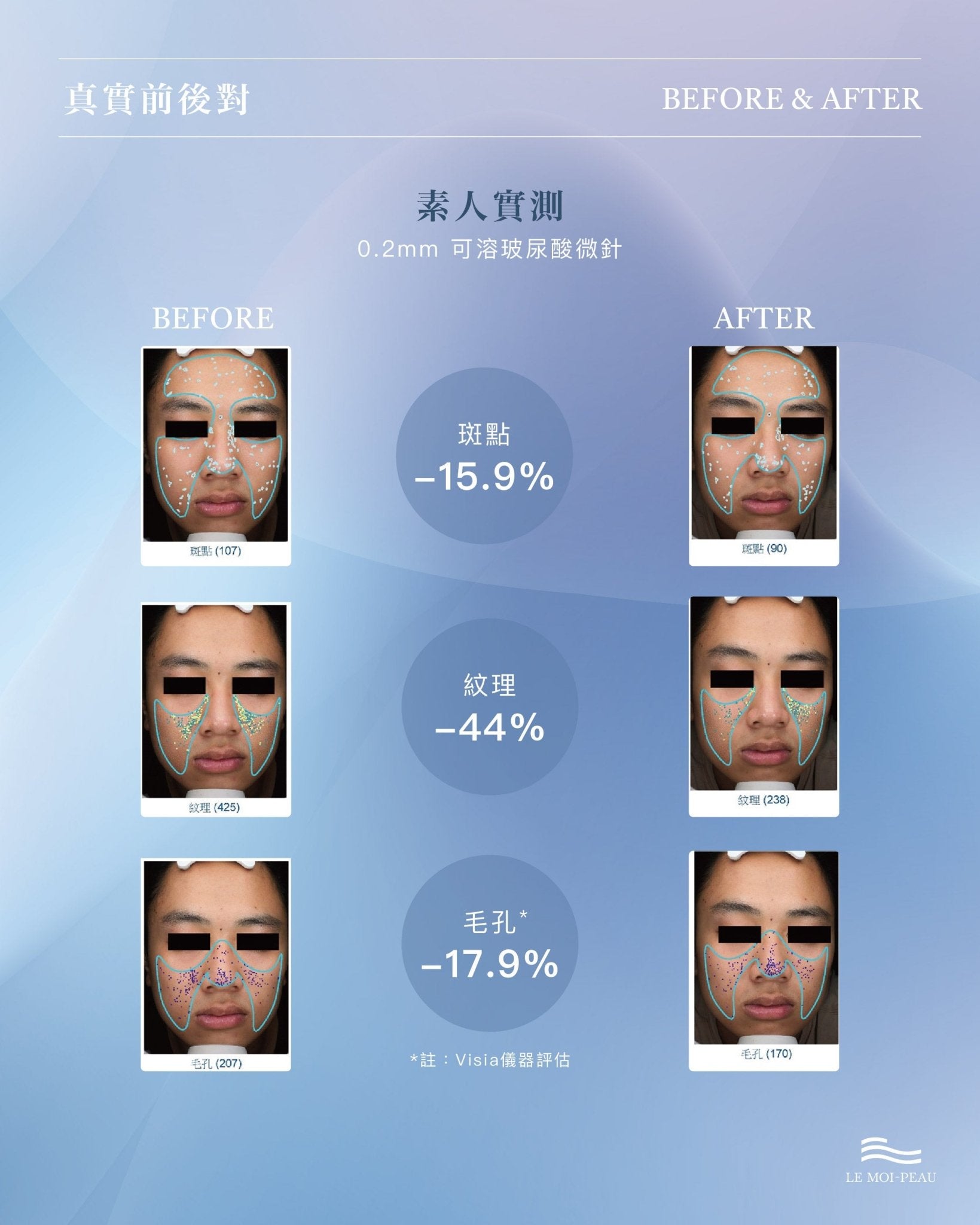 水玻超導滾輪 0.2mm - LEMOI - PEAU